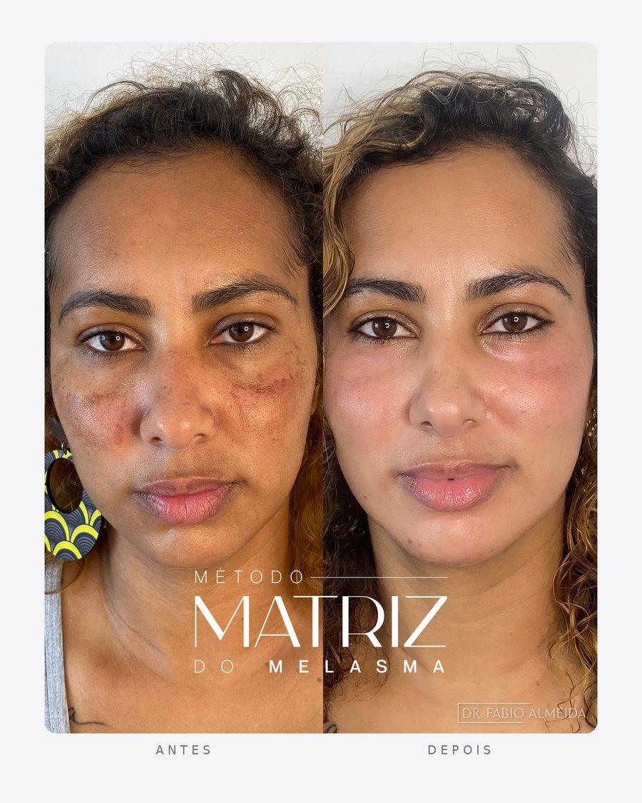 Antes e depois — método matriz do melasma
