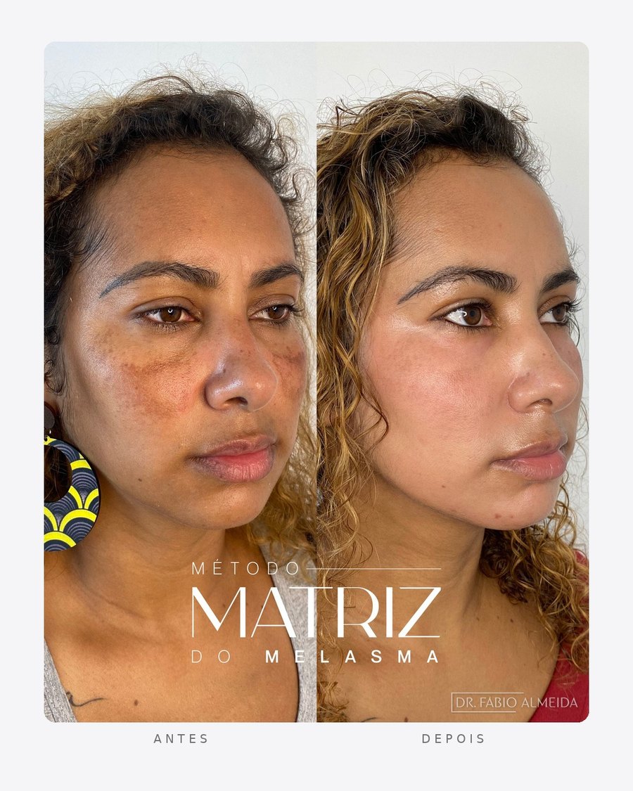 Antes e depois — método matriz do melasma, feminino · perfil direito