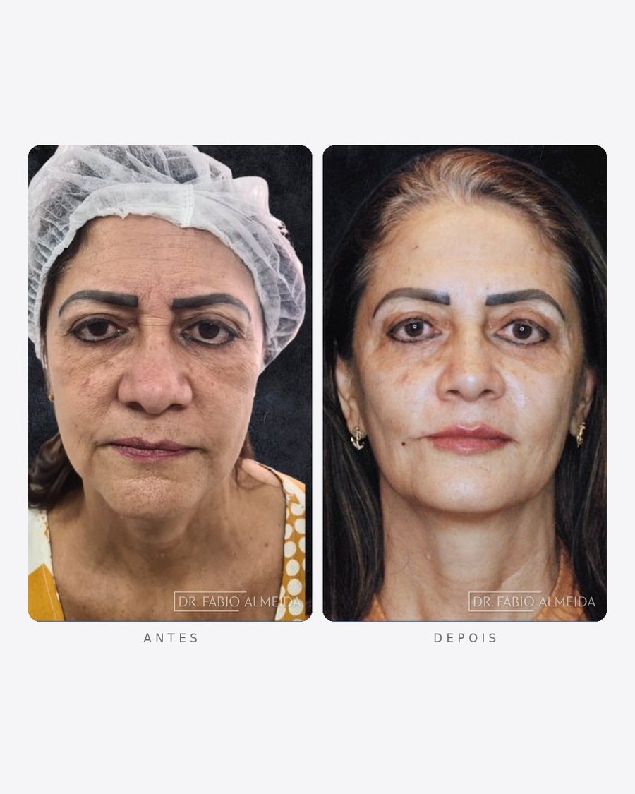 Antes e depois — rejuvenescimento facial