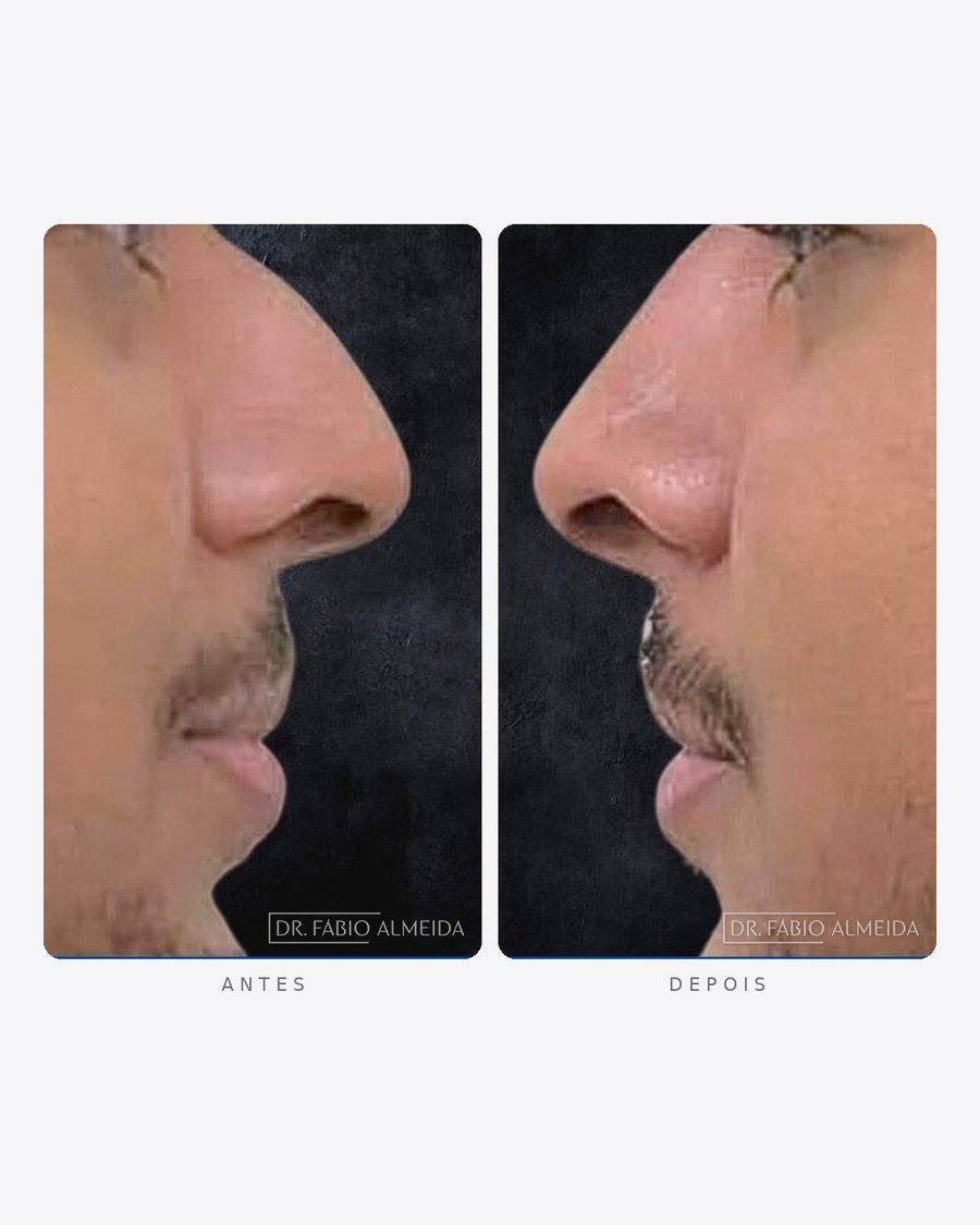 Antes e depois — rinomodelação, perfil