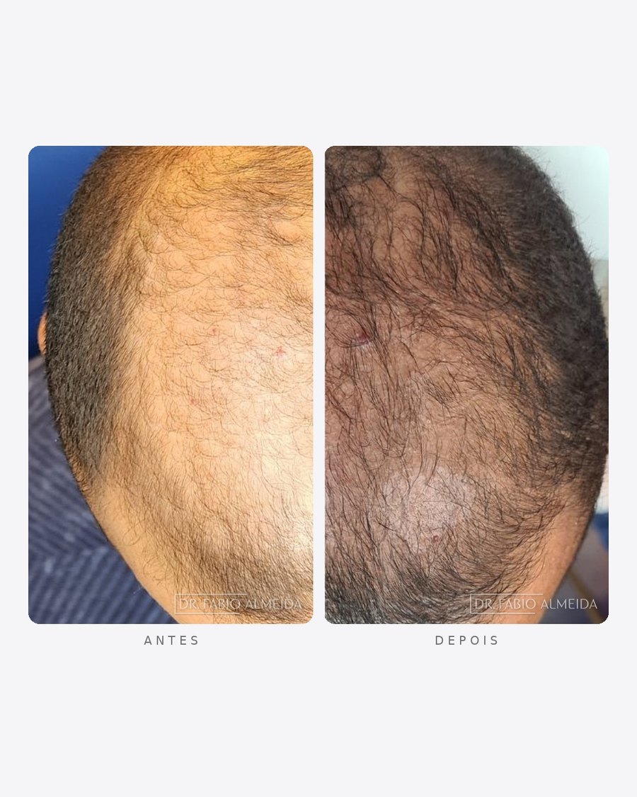Antes e depois — tratamento capilar, vértice