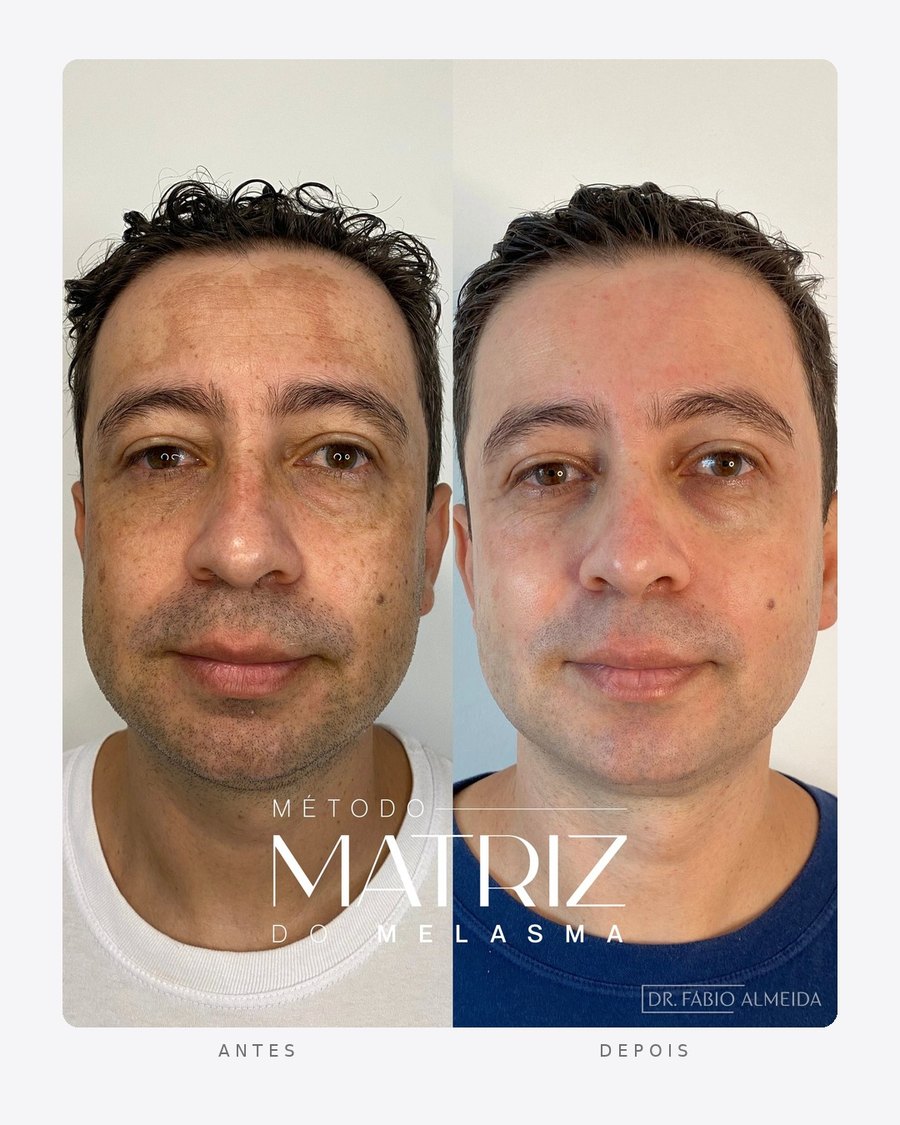 Antes e depois — método matriz do melasma, masculino · frente