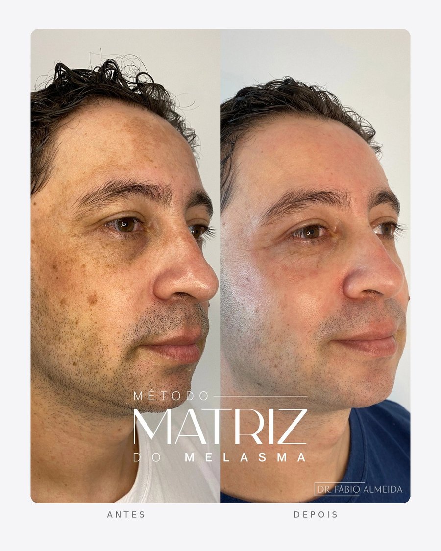 Antes e depois — método matriz do melasma, masculino · perfil direito