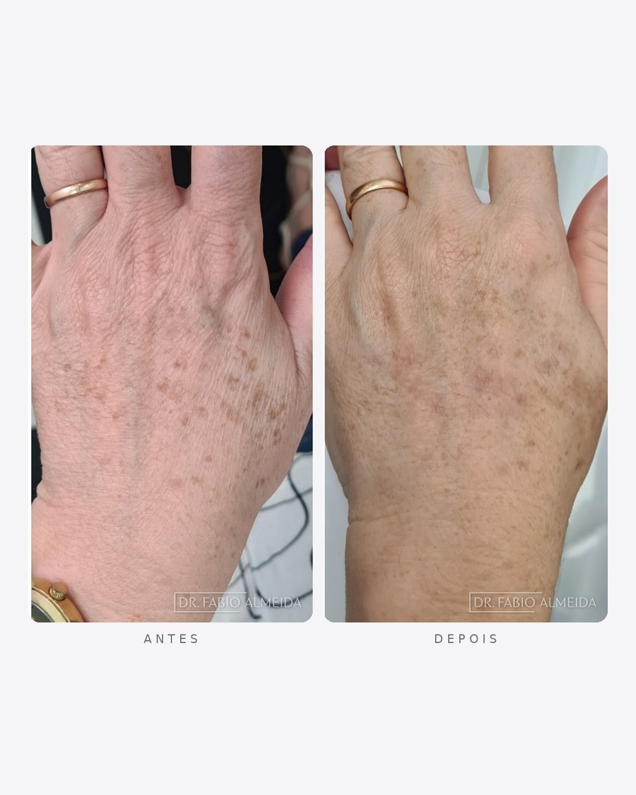 Antes e depois — rejuvenescimento de mãos, dorso das mãos