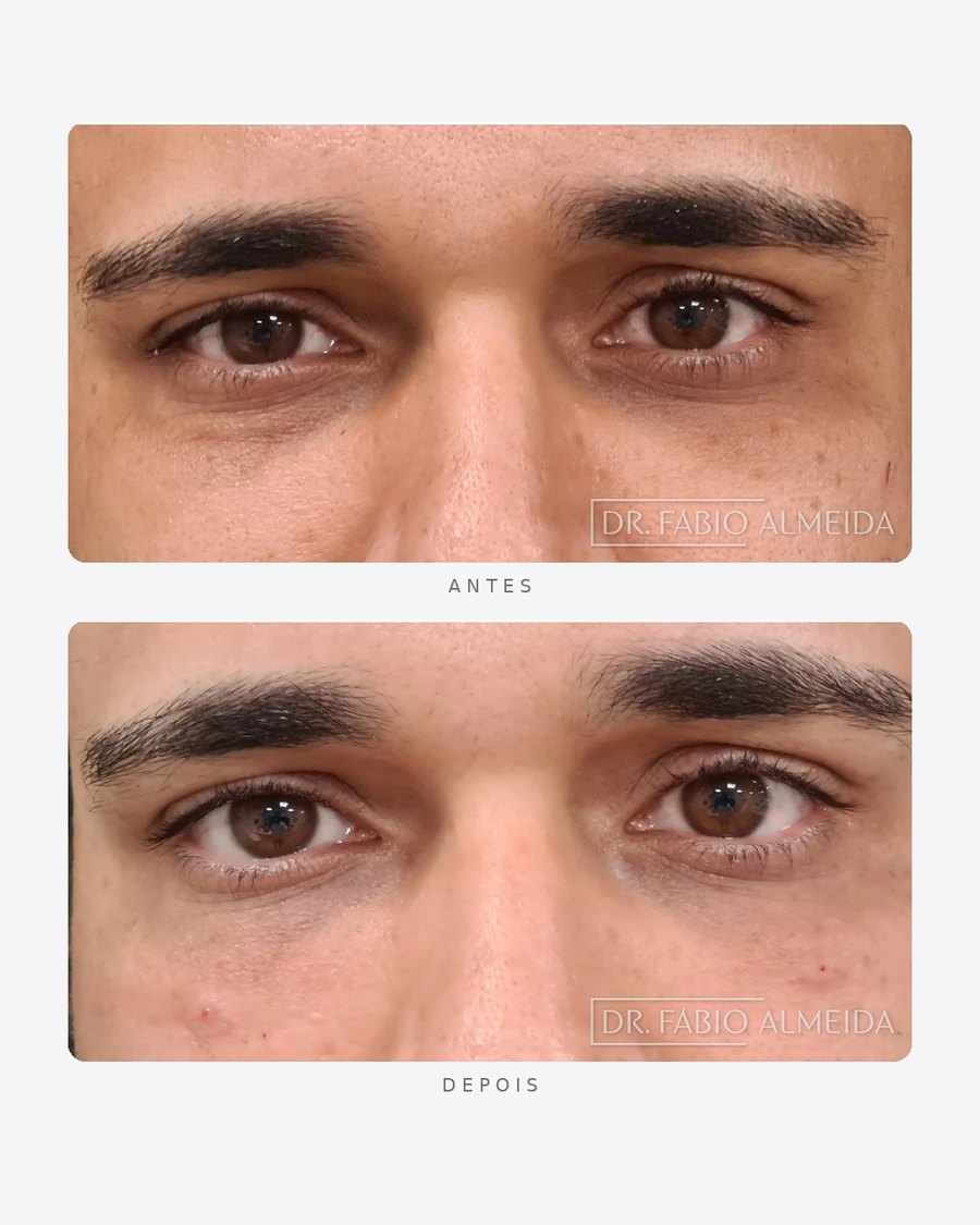 Antes e depois — preenchimento de olheiras, periorbital · masculino