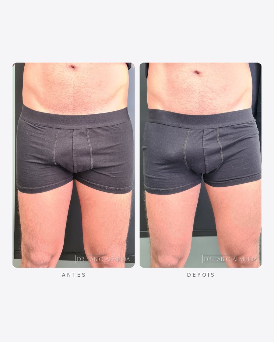 Antes e depois — definição abdominal, masculino · frente