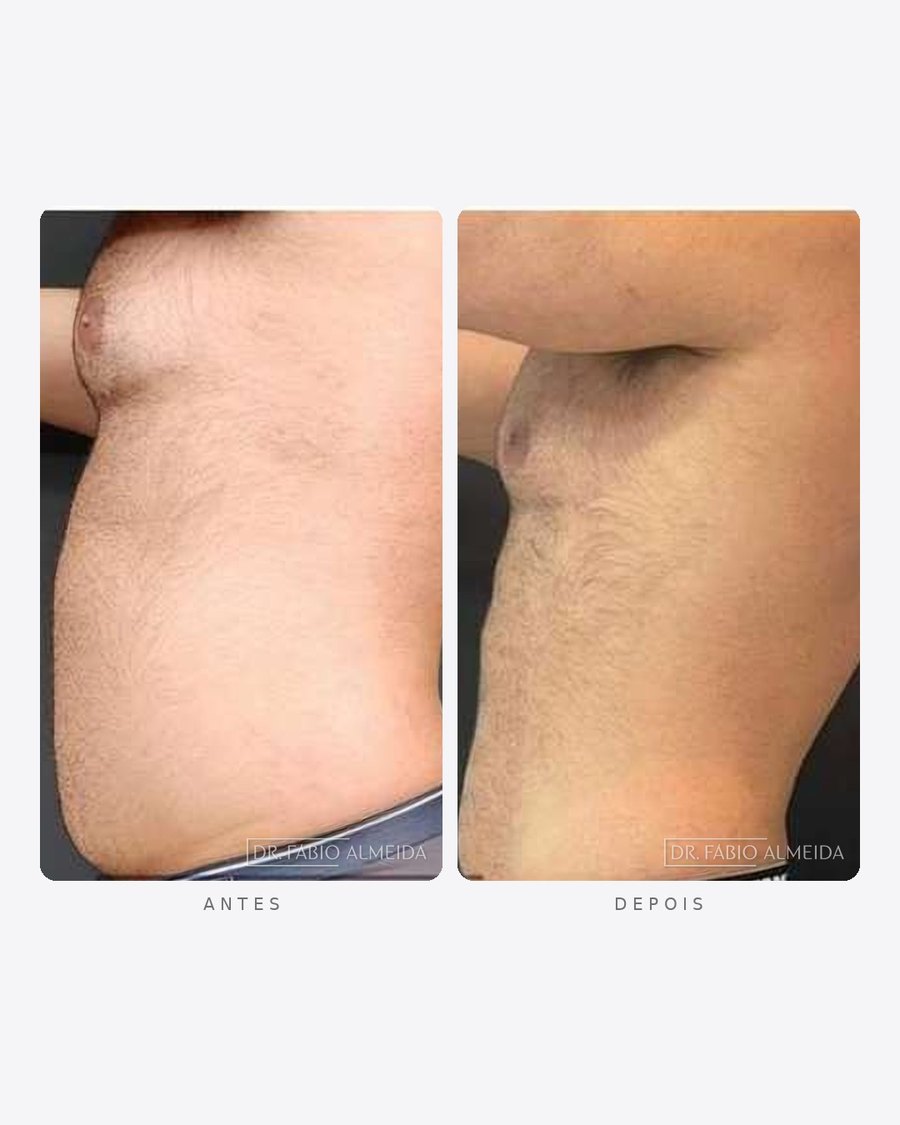 Antes e depois — redução de gordura abdominal, masculino · perfil