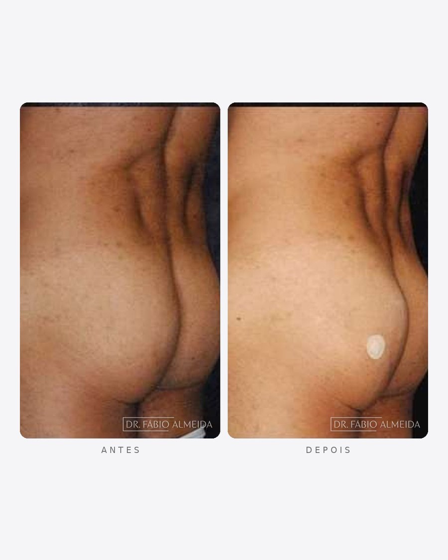 Antes e depois — harmonização de glúteos, feminino · perfil