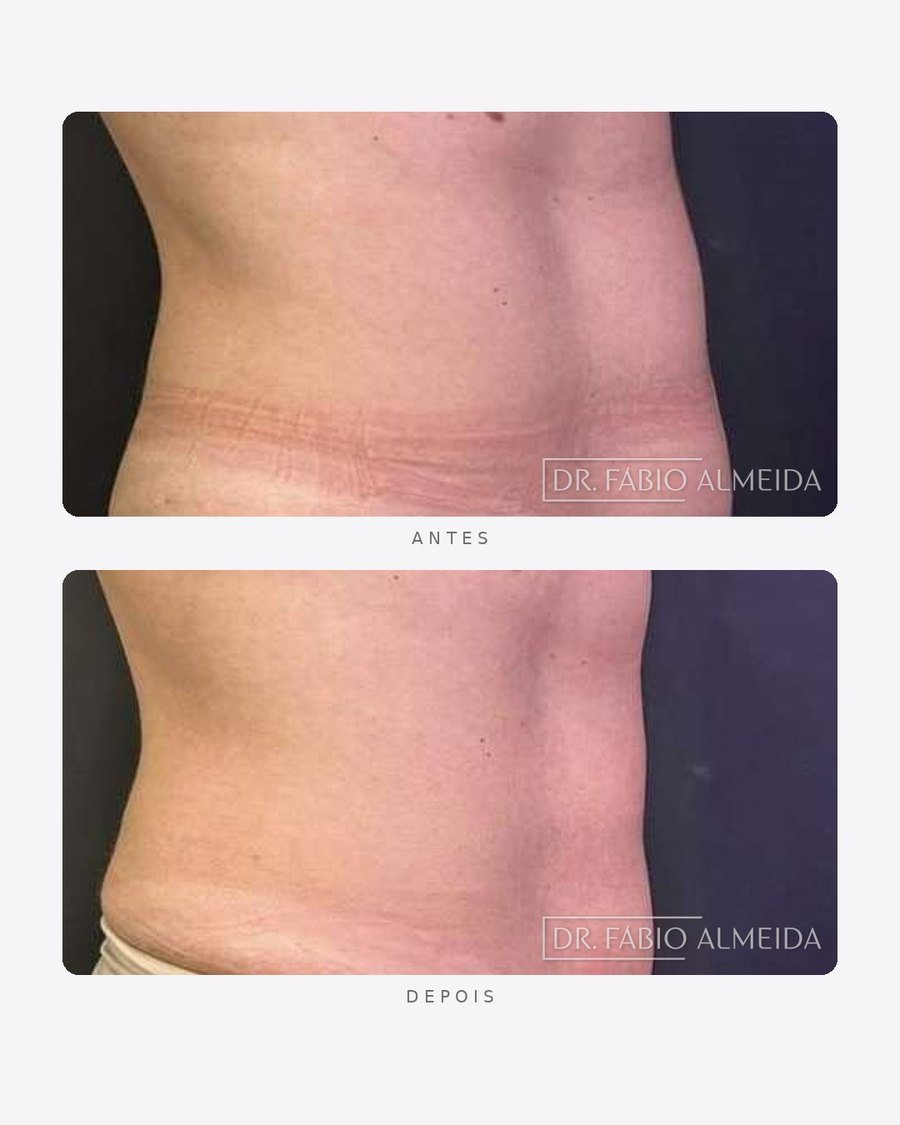Antes e depois — contorno abdominal — hybrius, feminino · perfil