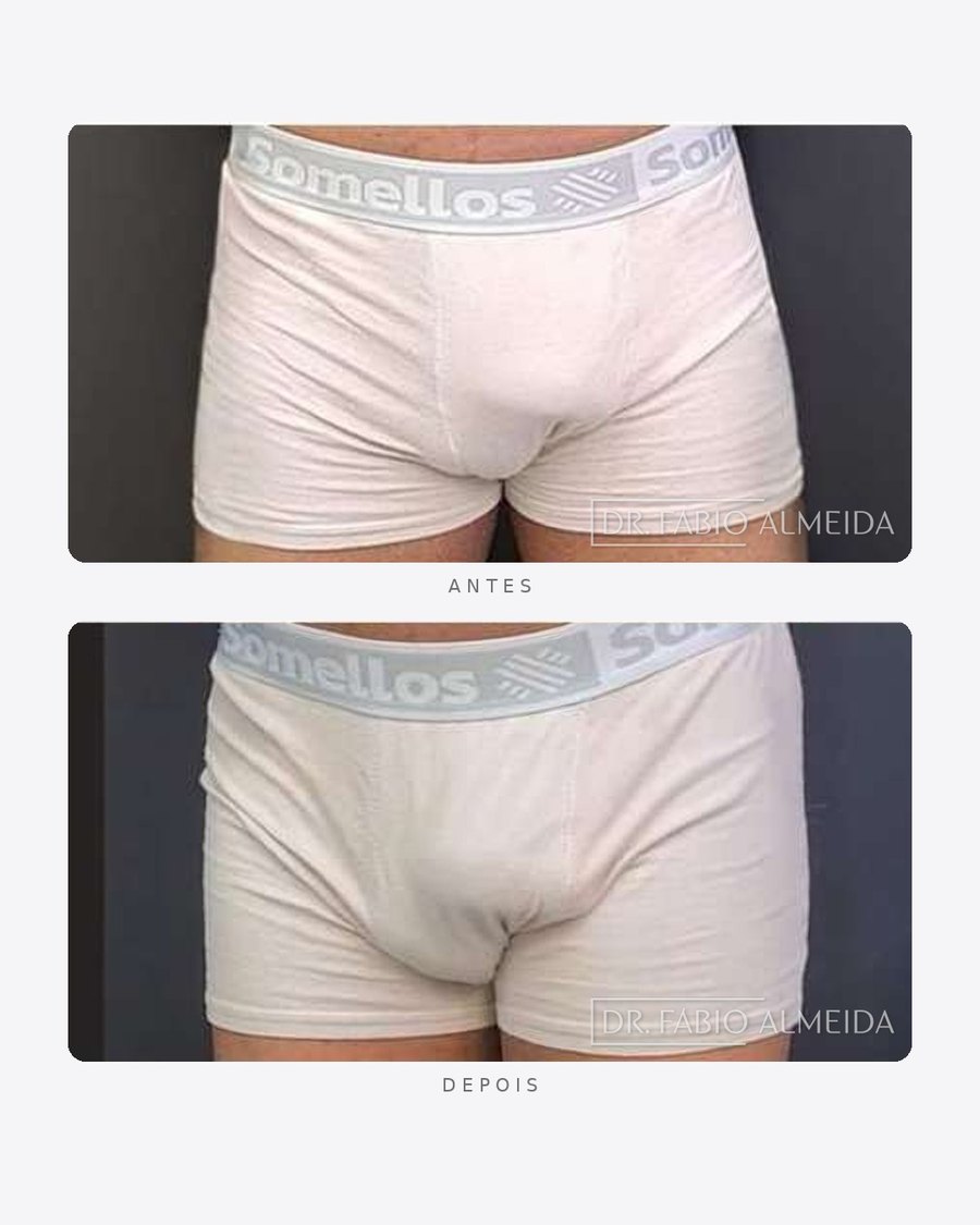 Antes e depois — faloplastia — preenchimento íntimo, masculino · frente · caso 1