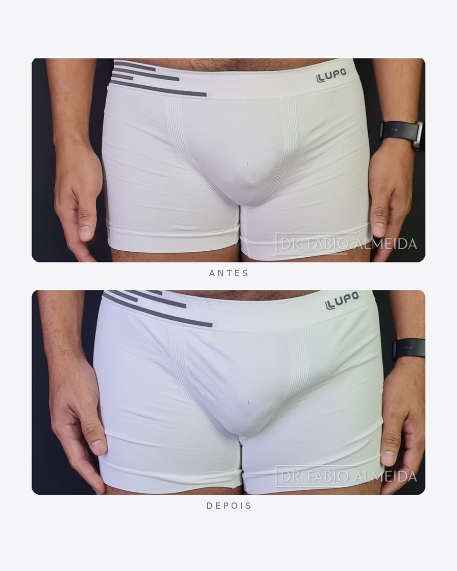 Antes e depois — faloplastia — preenchimento íntimo, masculino · frente · caso 2