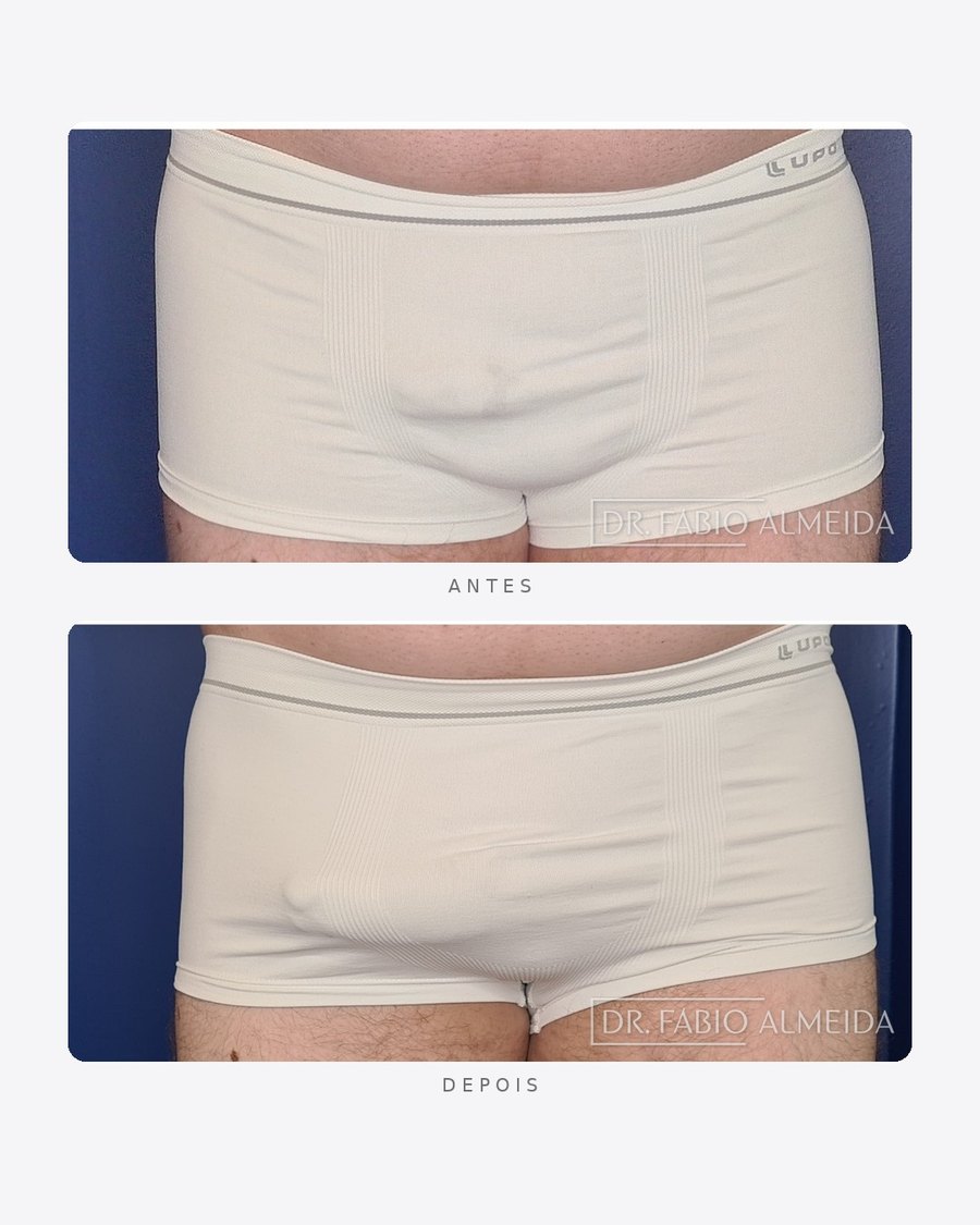 Antes e depois — faloplastia — preenchimento íntimo, masculino · frente · caso 3
