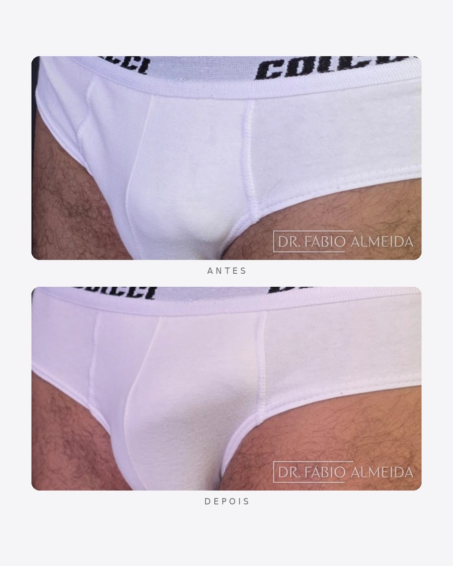 Antes e depois — faloplastia — preenchimento íntimo, masculino · oblíquo
