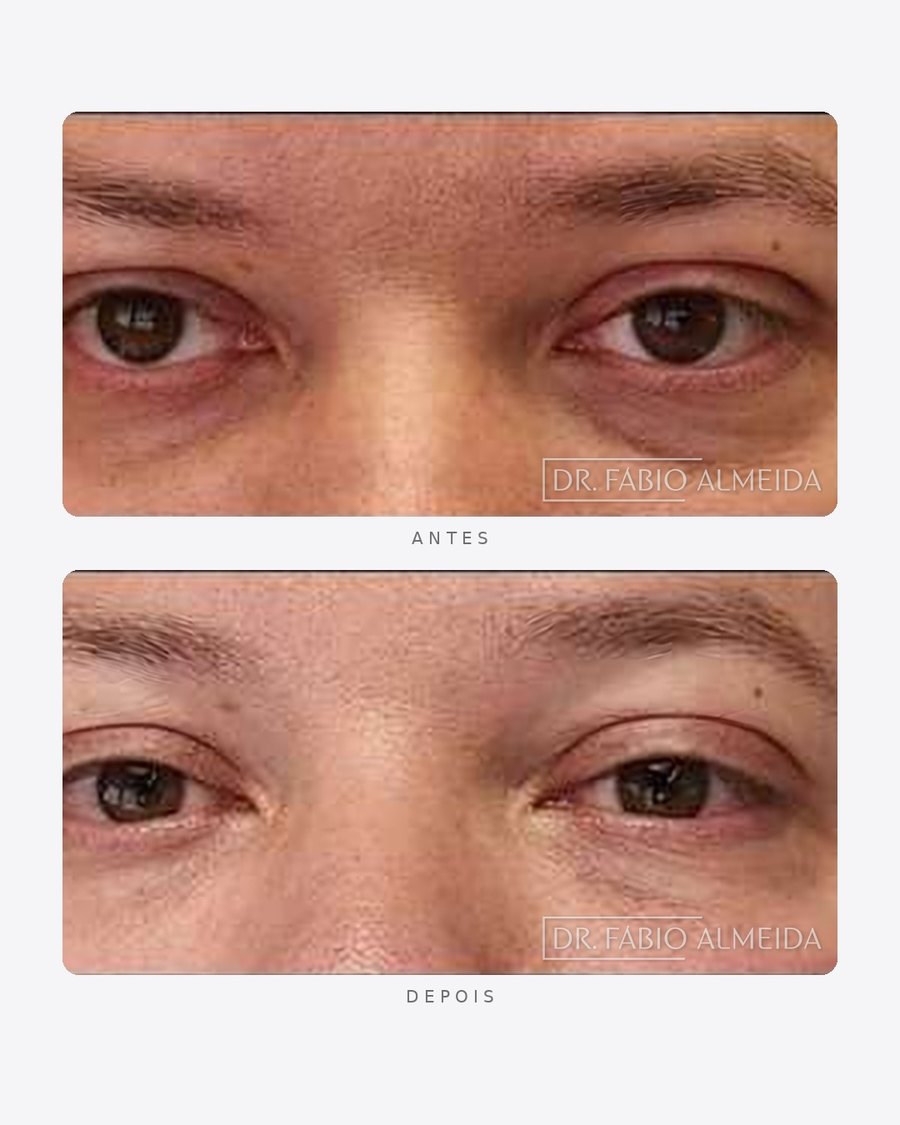 Antes e depois — preenchimento de olheiras, masculino · frente