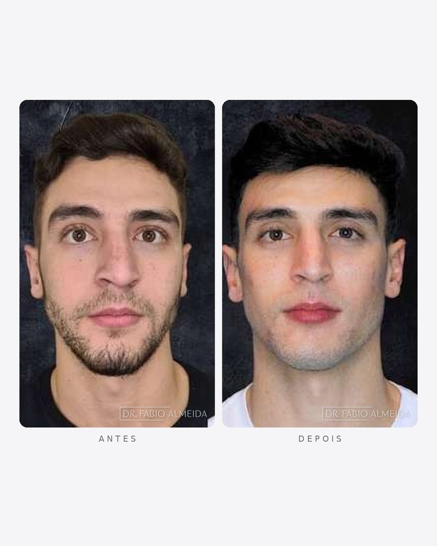 Antes e depois — preenchimento de mandíbula