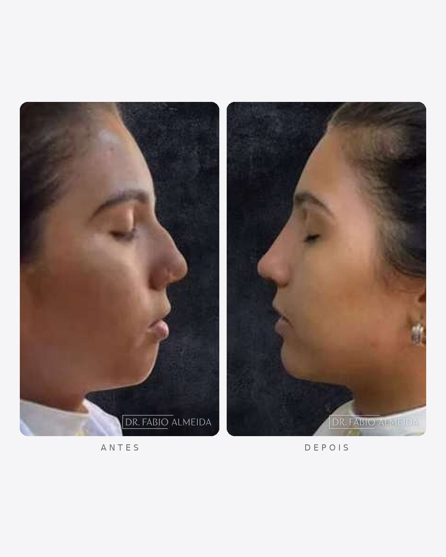 Antes e depois — papada e nariz, feminino · perfil