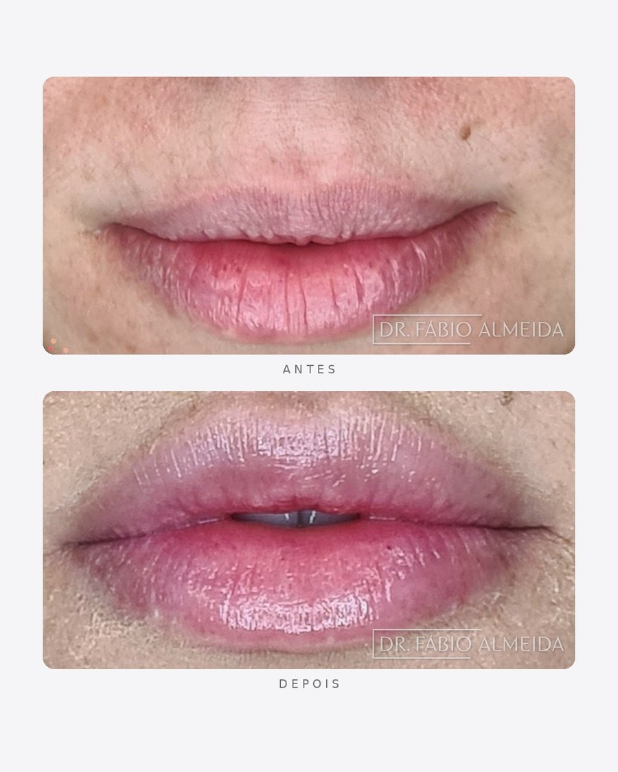 Antes e depois — preenchimento labial