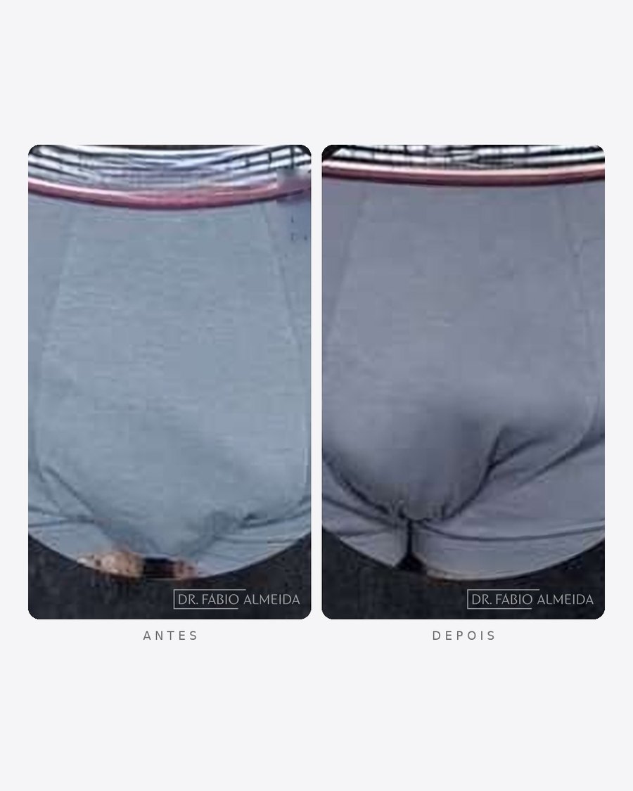 Antes e depois — faloplastia — preenchimento íntimo, masculino · frente · caso 7