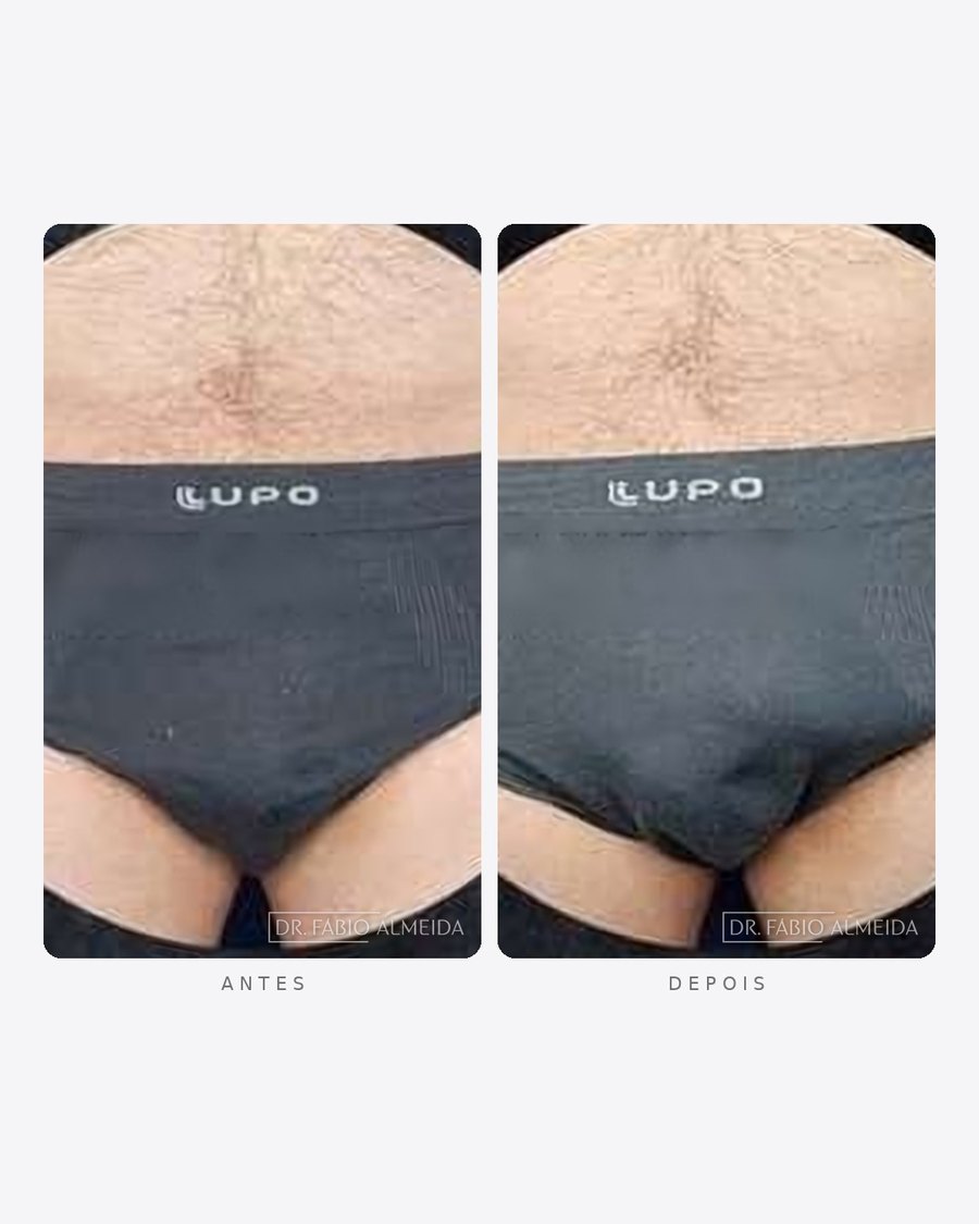 Antes e depois — faloplastia — preenchimento íntimo, masculino · frente · caso 9