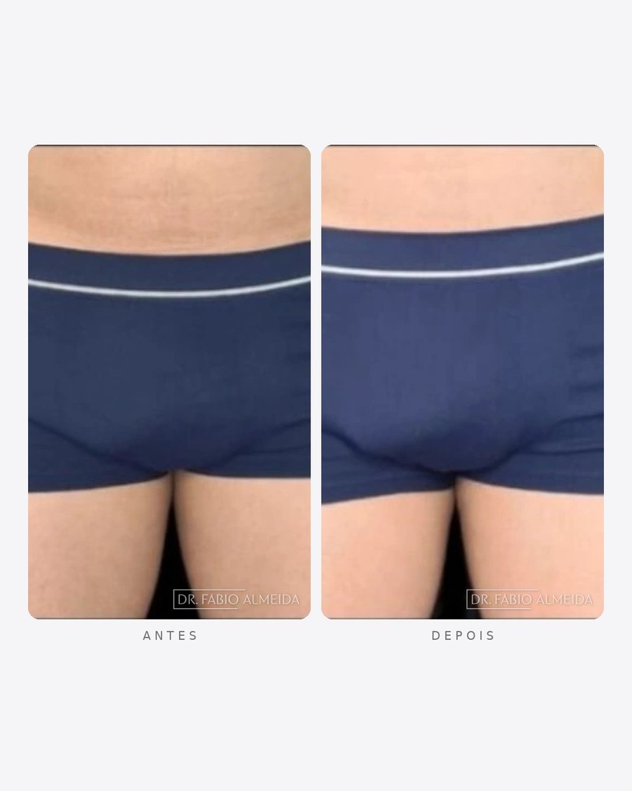 Antes e depois — faloplastia — preenchimento íntimo, masculino · frente e perfil · caso 11