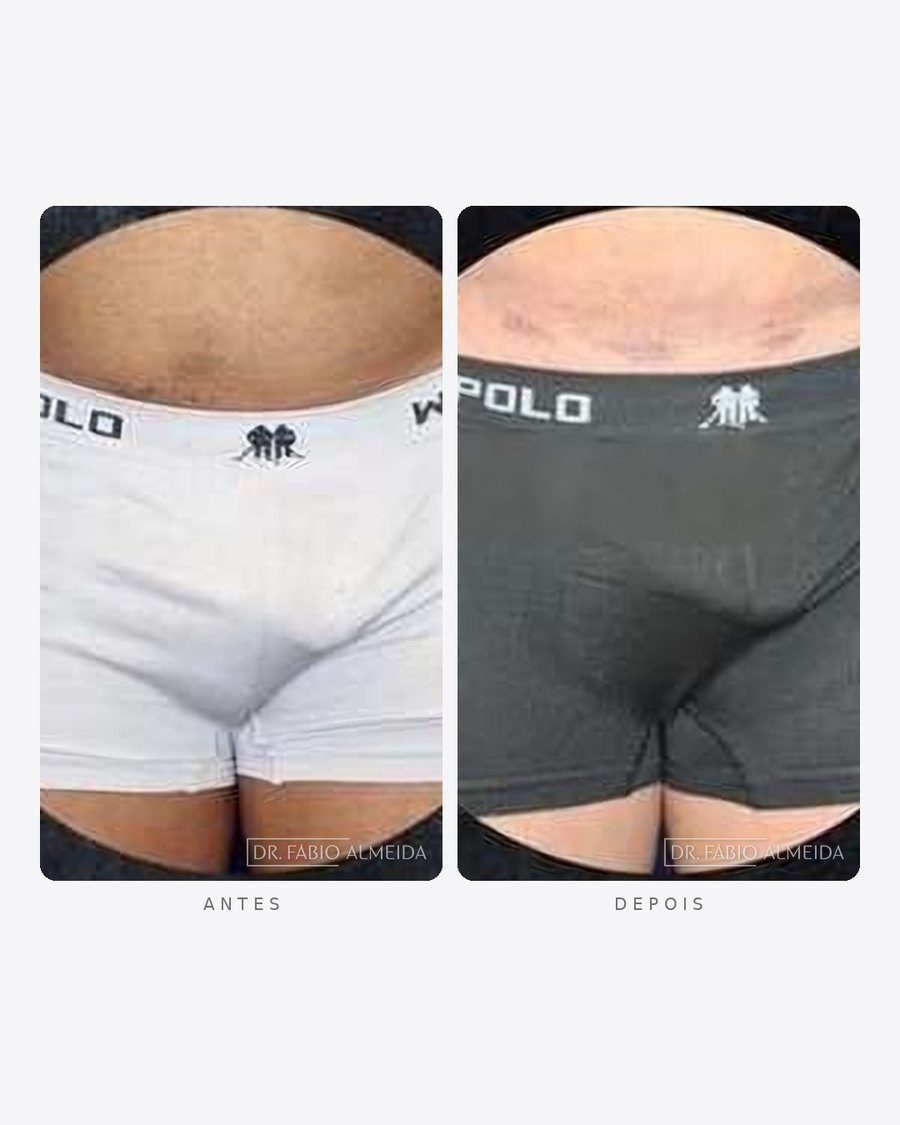 Antes e depois — faloplastia — preenchimento íntimo, masculino · frente · caso 12